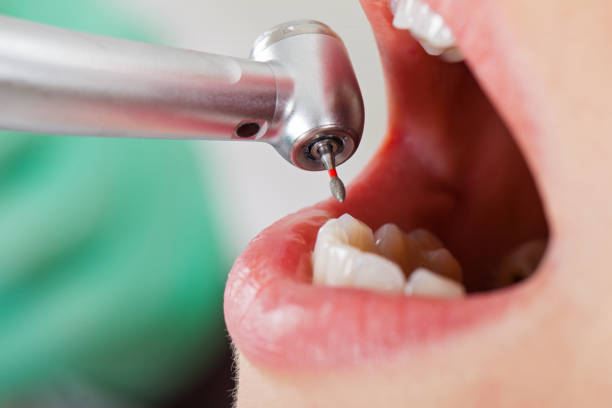 Best Emergency Tooth Extraction in King City, CA
